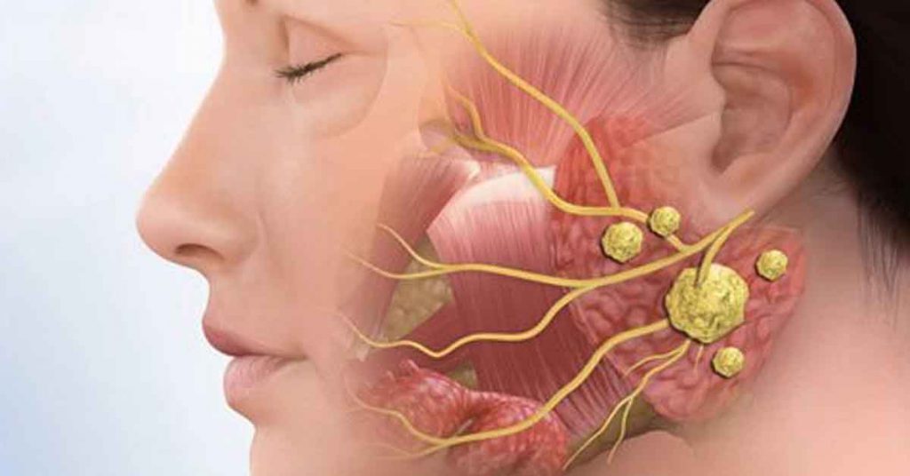 Cirurgia para tratamento de tumores da glândula salivar