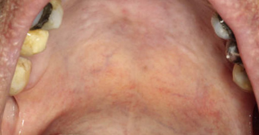 Cirurgia para tratamento de Câncer de Palato